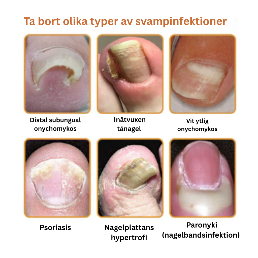 Propofix™ | Hjälper till att minska nagelsvamp och förbättra naglarnas utseende på upp till 7 dagar.