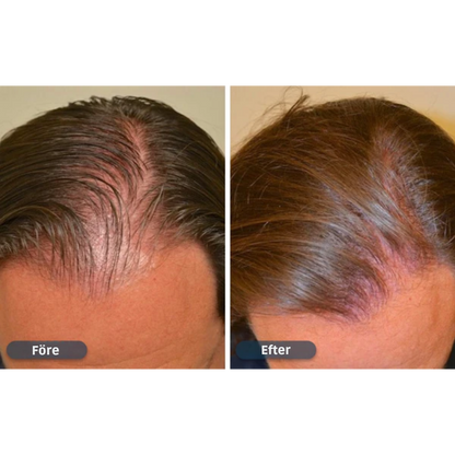 HårVäxt™ – Minoxidil lotion 5 % (1 månads förråd)