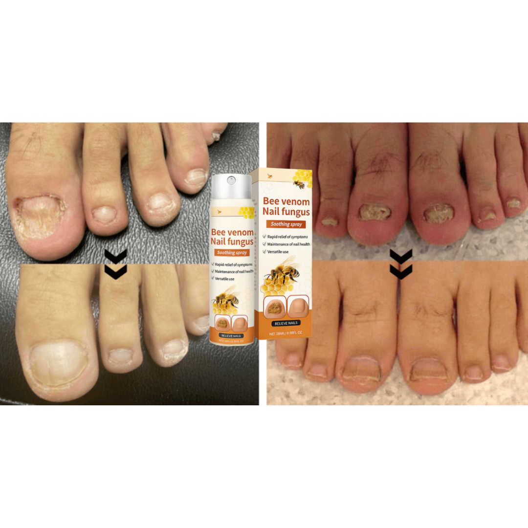 Propofix™ | Hjälper till att minska nagelsvamp och förbättra naglarnas utseende på upp till 7 dagar.